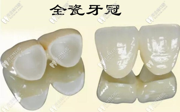 烤瓷牙邊緣發(fā)黑的修復方法