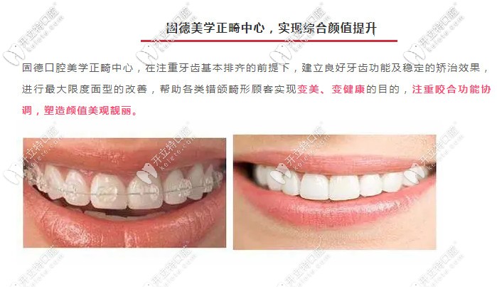 東莞牙齒矯正的費(fèi)用