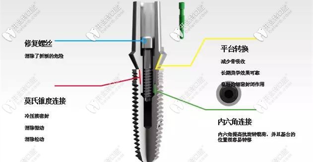 選擇種植牙，方方面面都要考慮到位