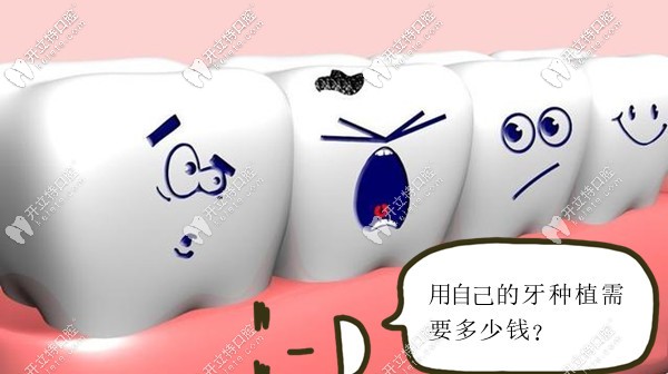 用自己的牙種植需要多少錢(qián)呢