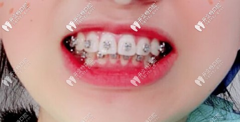 剛粘上托槽時(shí)拍的自拍照