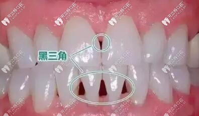 牙齒矯正黑三角