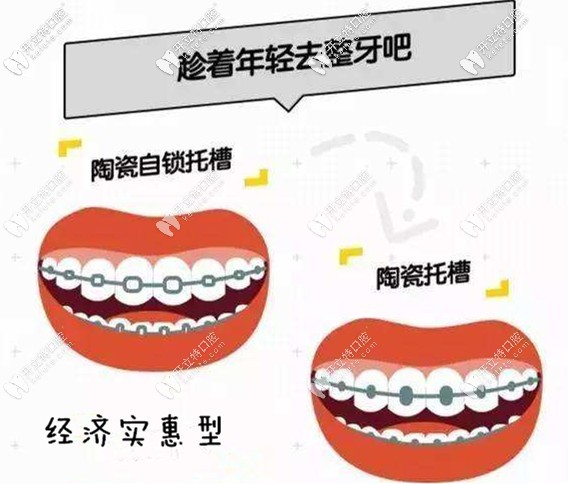 經(jīng)濟(jì)實惠型—陶瓷自鎖托槽