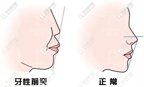 看到許多人在整牙后改變了側貌