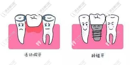 活動假牙和種植牙哪個好