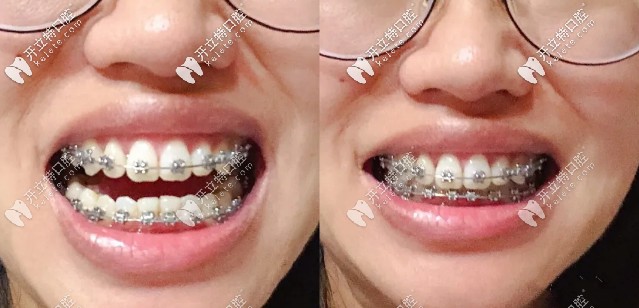 矯正后期效果對比圖