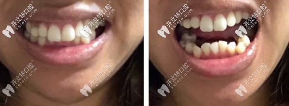 矯正前牙齒的照片
