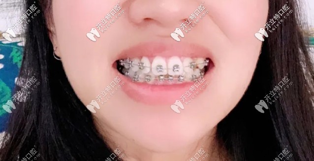 快該摘掉牙套啦，牙齒已經(jīng)排齊了