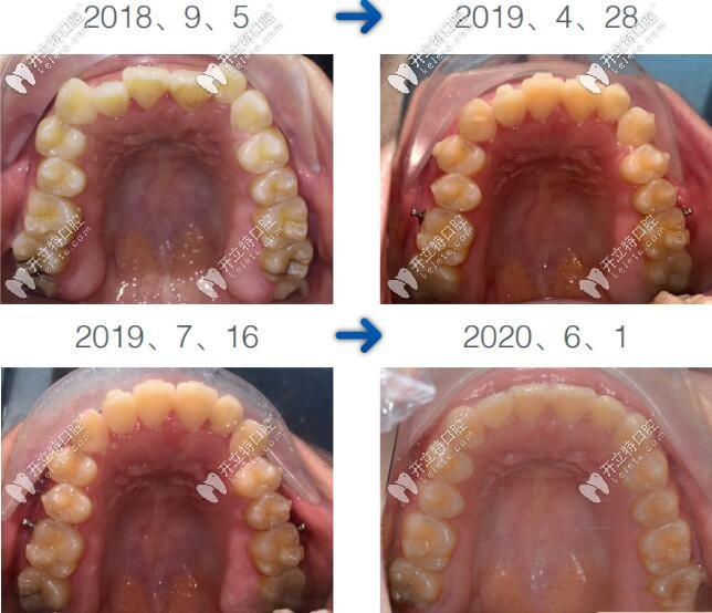 時代天使隱形矯正案例