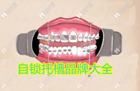 金屬自鎖牙套品牌大全匯總,說說國產(chǎn)和進(jìn)口到底有啥區(qū)別？