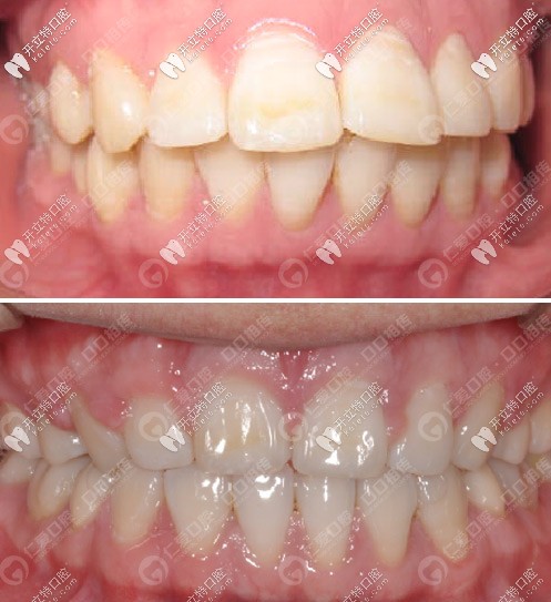 <!--<i data=20240703-sp></i>-->口腔齙牙前突矯正案例對(duì)比△