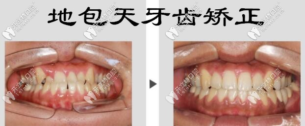 <!--<i data=20240703-sp></i>-->地包天牙齒矯正案例