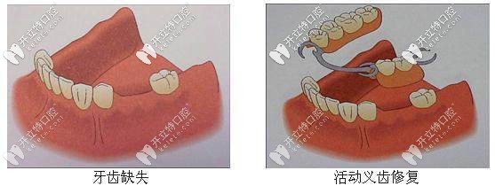 活動(dòng)義齒修復(fù)