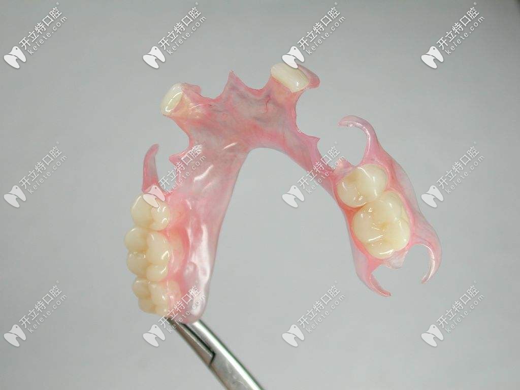 活動(dòng)假牙種類