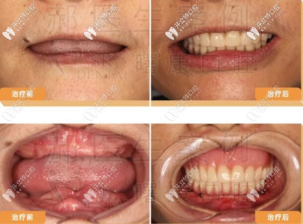 <!--<i data=20240703-sp></i>-->曙康口腔全口種植牙案例前后對比圖