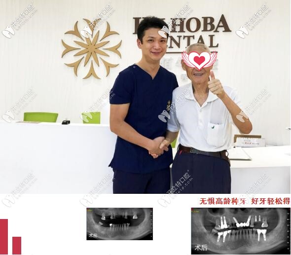 東莞好佰年口腔微創(chuàng)多顆種植牙案例