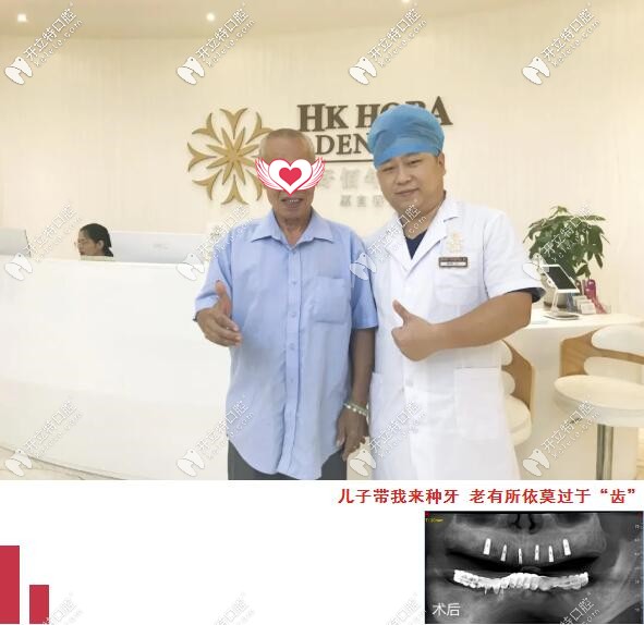 半口種植牙案例 東莞好佰年口腔門診部