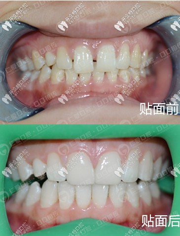 門(mén)牙稀疏美加超薄瓷貼面真人案例 <!--<i data=20240703-sp></i>-->口腔 門(mén)牙稀疏美加超薄瓷貼面真人案例 <!--<i data=20240703-sp></i>-->口腔