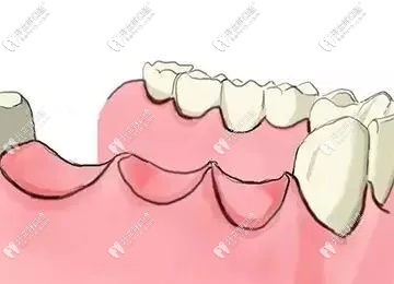 多顆缺牙種植活動