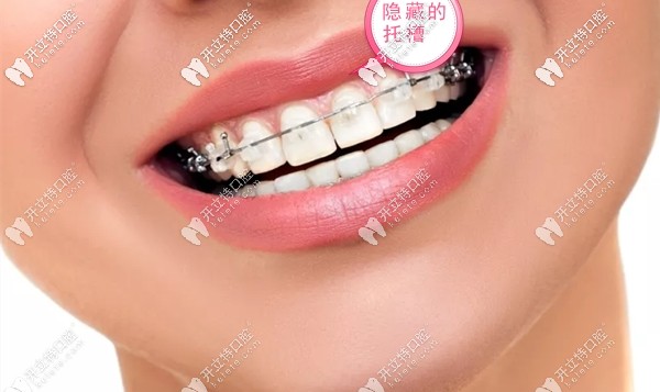 戴冰晶半隱形牙套的禁忌事項(xiàng)