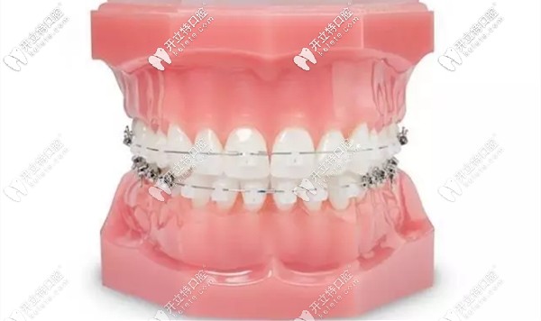 冰晶托槽有是國(guó)產(chǎn)和進(jìn)口之分的