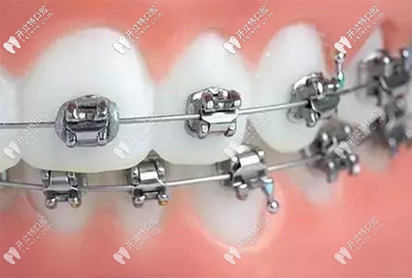 普特自鎖牙套矯正方式