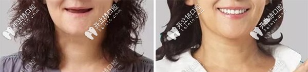 深圳韋博種植牙案例