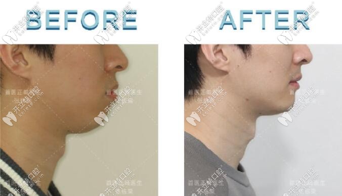 來看看張棟梁矯正效果怎么樣