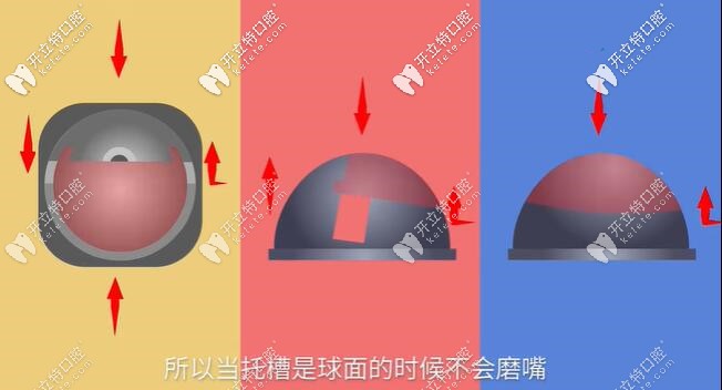 球面自鎖托槽表面力的運動方向