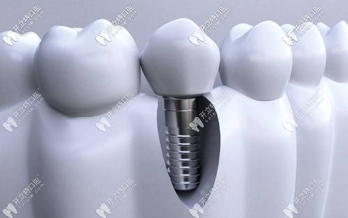 湖州鼎植口腔種植牙