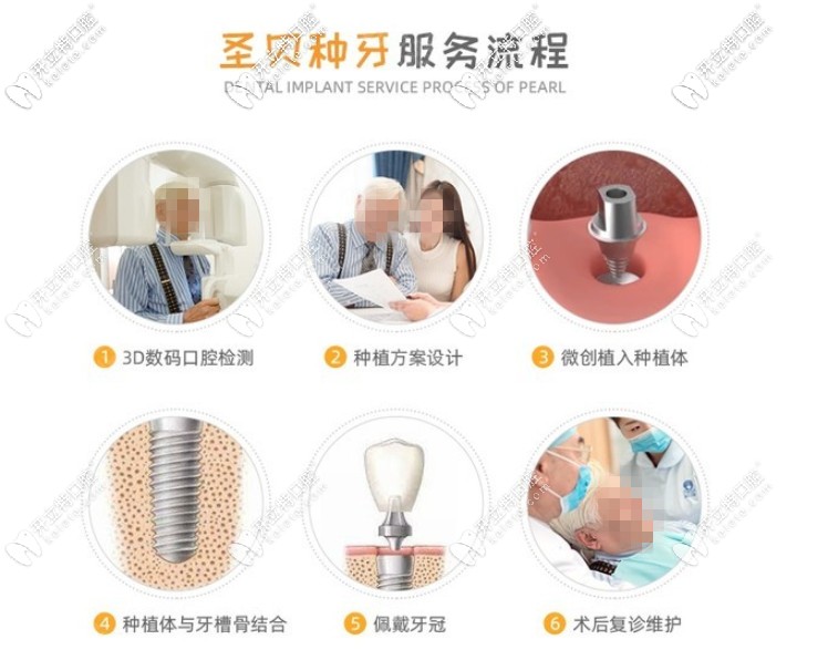 圣貝口腔種植牙步驟