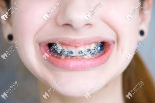 剛戴牙套時的脹痛