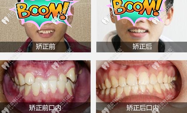 深圳格倫菲爾口腔地包天牙齒矯正案例