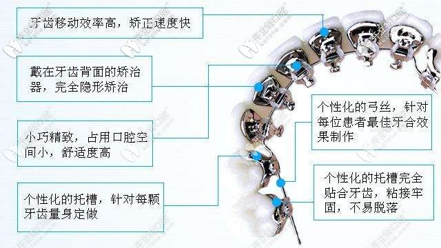 舌側(cè)矯正的特點(diǎn) 