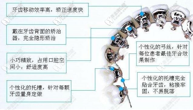 舌側(cè)矯正優(yōu)勢