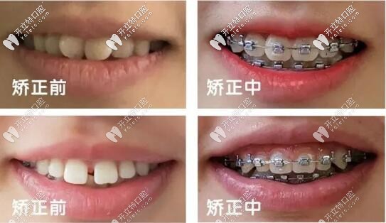 牙齒矯正過程變化圖
