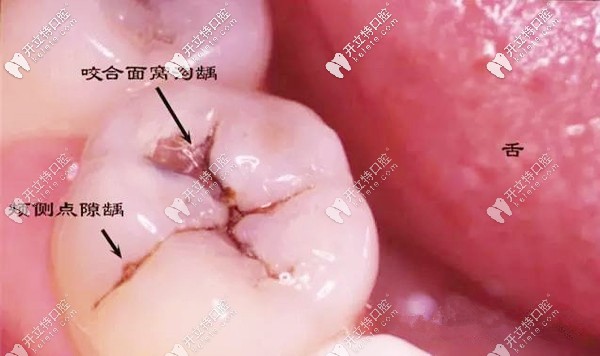 牙齒表面有黑點(diǎn)就是蛀牙哦,此時(shí)補(bǔ)牙能省很多錢呢！