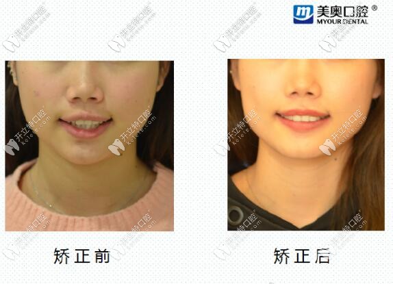 親測(cè)長(zhǎng)沙美奧口腔醫(yī)院靠譜,看我短下巴金屬矯正1年的效果