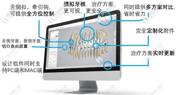 Spark精靚隱形矯治系統(tǒng)的控根技術介紹