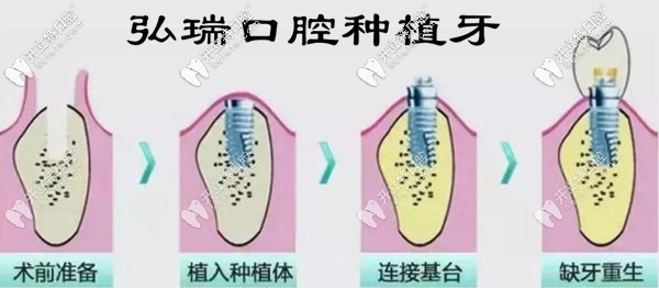 <!--<i data=20240703-sp></i>-->口腔種植牙特色 <!--<i data=20240703-sp></i>-->口腔種植牙特色