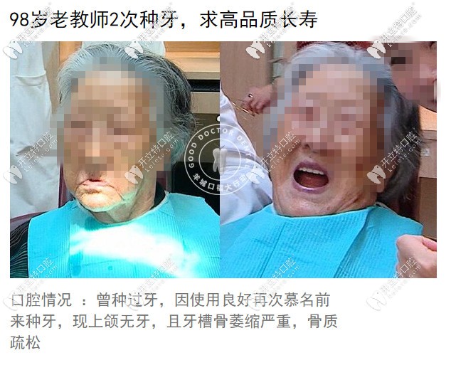 廣州好大夫種植牙實例