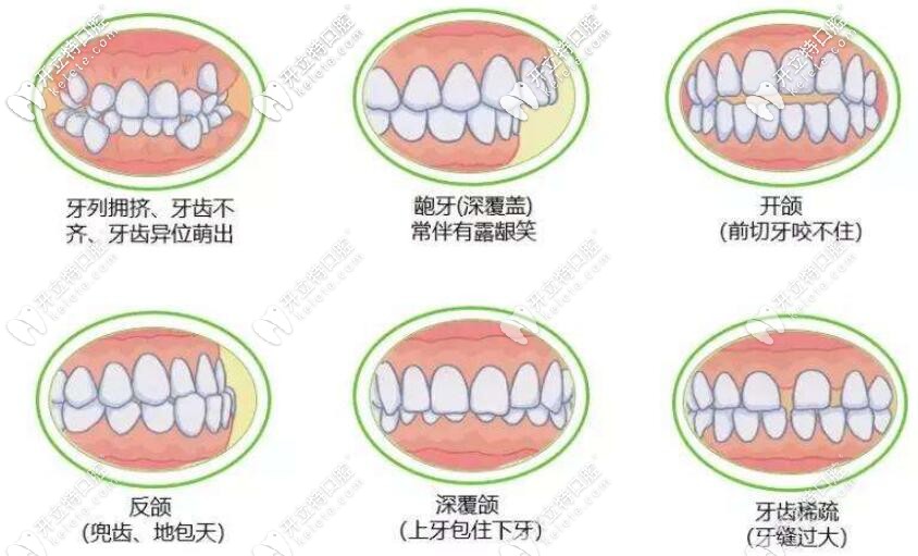 各種牙齒不齊趁早矯正