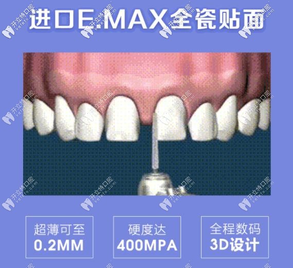 牙齒修復(fù)黑科技：emax貼面是鑄瓷還是玻璃陶瓷你了解嗎