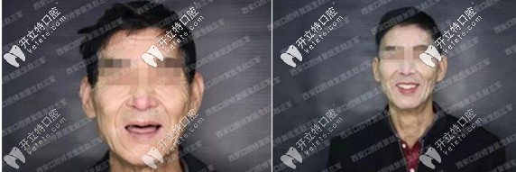 西安圣貝種植牙案例