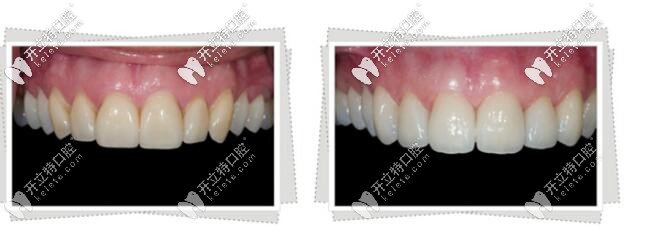 美奧口腔超薄瓷貼面效果圖