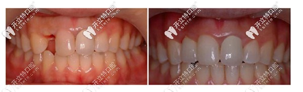 瑞士straumann種植體優(yōu)勢(shì)