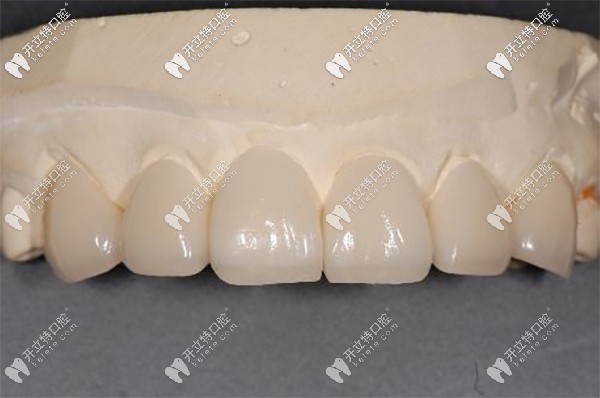 門牙瓷貼面的適應(yīng)證和優(yōu)點(diǎn)