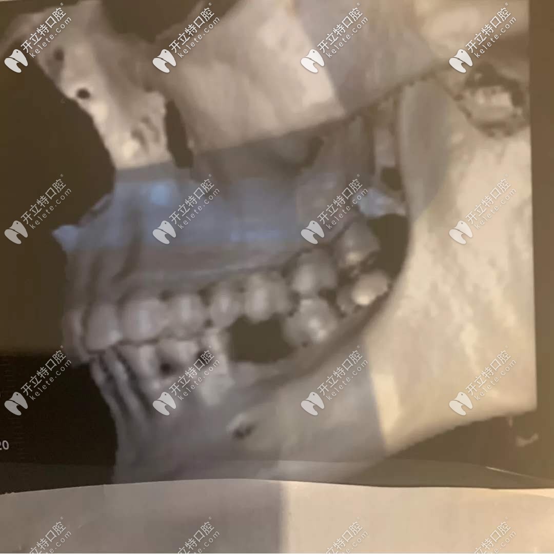 分享我在韶關(guān)比較好的牙科診所做瑞士ITI種植牙過程及經(jīng)歷