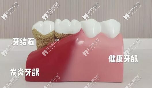 牙結(jié)石的危害
