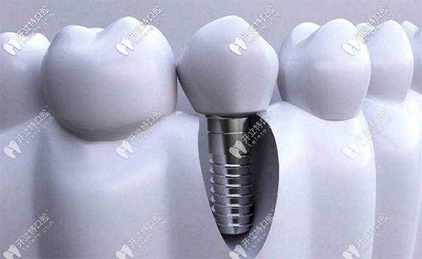 即刻種植牙和傳統(tǒng)種植優(yōu)缺點